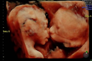 Zdjęcie bliźniaków wykonanych podczas badania USG  Fot.: portal today.com